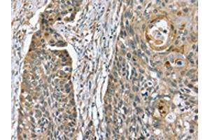 The image on the left is immunohistochemistry of paraffin-embedded Human esophagus cancer tissue using ABIN7130610(PHLPP1 Antibody) at dilution 1/35, on the right is treated with fusion protein. (PHLPP1 Antikörper)