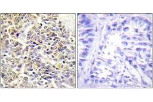 Immunohistochemistry analysis of paraffin-embedded human lung carcinoma tissue, using ASC Antibody. (STS Antikörper  (AA 10-59))