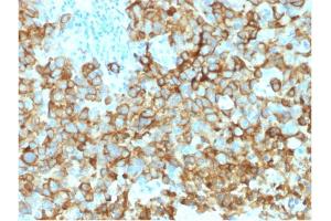 Formalin-fixed, paraffin-embedded human Melanoma stained with gp100 Mouse Monoclonal Antibody (PMEL/2039). (Melanoma gp100 Antikörper  (AA 376-502))