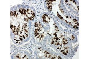 IHC-P: p107 antibody testing of human intestinal cancer tissue (p107 Antikörper  (C-Term))