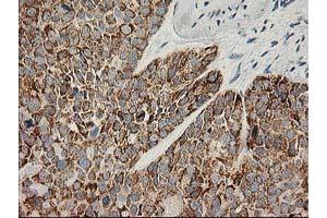 Immunohistochemical staining of paraffin-embedded Adenocarcinoma of Human breast tissue using anti-AK4 mouse monoclonal antibody. (AK4 Antikörper)