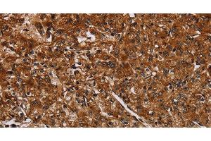 Immunohistochemistry of paraffin-embedded Human prostate cancer using ACP6 Polyclonal Antibody at dilution of 1:30 (ACP6 Antikörper)