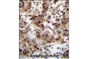 ZN Antibody (N-term) (ABIN655359 and ABIN2844918) immunohistochemistry analysis in formalin fixed and paraffin embedded human breast carcinoma followed by peroxidase conjugation of the secondary antibody and DAB staining. (ZNF321P Antikörper  (N-Term))