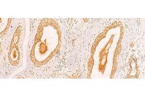 Immunohistochemistry of paraffin-embedded Human breast cancer tissue using ZNF580 Polyclonal Antibody at dilution of 1:40(x200) (ZNF580 Antikörper)