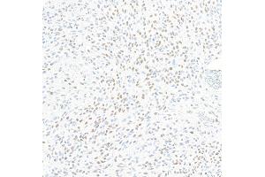 Immunohistochemistry (IHC) image for anti-Zinc Finger E-Box Binding Homeobox 1 (ZEB1) (AA 750-800) antibody (ABIN7455173) (Rekombinanter ZEB1 Antikörper  (AA 750-800))