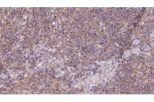 ABIN6273189 at 1/100 staining Human lymph cancer tissue by IHC-P.