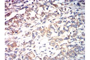 Immunohistochemical analysis of paraffin-embedded bladder cancer tissues using CALR mouse mAb with DAB staining. (Calreticulin Antikörper  (AA 18-417))
