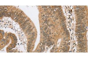 Immunohistochemistry of paraffin-embedded Human colon cancer using ARHGAP25 Polyclonal Antibody at dilution of 1:40 (ARHGAP25 Antikörper)
