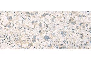 Immunohistochemistry of paraffin-embedded Human liver cancer tissue using SPSB2 Polyclonal Antibody at dilution of 1:70(x200) (SPSB2 Antikörper)