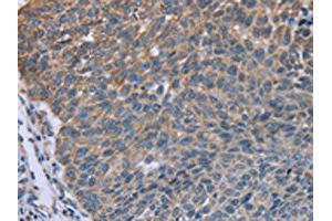 The image on the left is immunohistochemistry of paraffin-embedded Human lung cancer tissue using ABIN7129622(GNAI3 Antibody) at dilution 1/30, on the right is treated with fusion protein. (GNAI3 Antikörper)