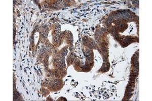 Immunohistochemical staining of paraffin-embedded liver tissue using anti-KIAA1609 mouse monoclonal antibody. (KIAA1609 Antikörper)