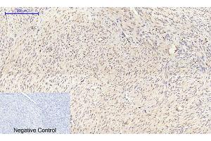 Immunohistochemical analysis of paraffin-embedded human uterus cancer tissue. (Connexin 43/GJA1 Antikörper  (AA 310-390))