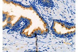 ABIN6260857 and ABIN6266905 at 1/100 staining Human prostate cancer by IHC-P.