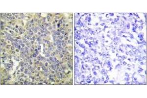 Immunohistochemistry analysis of paraffin-embedded human lung carcinoma, using Caspase 9 (Phospho-Thr125) Antibody. (Caspase 9 Antikörper  (pThr125))