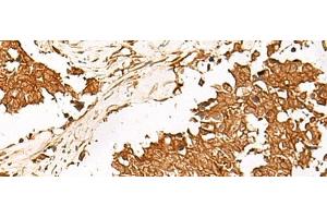 Immunohistochemistry of paraffin-embedded Human lung cancer tissue using HUS1 Polyclonal Antibody at dilution of 1:65(x200) (HUS1 Antikörper)