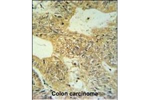 CLDN23 Antibody (C-term) (ABIN653789 and ABIN2843074) IHC analysis in formalin fixed and paraffin embedded colon carcinoma followed by peroxidase conjugation of the secondary antibody and DAB staining. (Claudin 23 Antikörper  (C-Term))