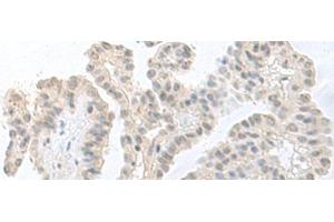 Immunohistochemistry of paraffin-embedded Human thyroid cancer tissue using RPS27L Polyclonal Antibody at dilution of 1:55(x200)