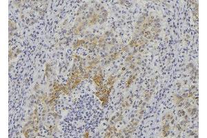 ABIN6276395 at 1/100 staining Human lung cancer tissue by IHC-P. (Endothelin 1 Antikörper  (C-Term))
