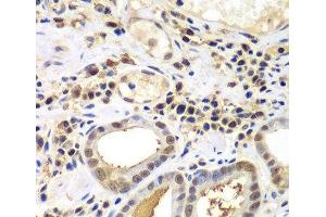 Immunohistochemistry of paraffin-embedded Human gastric cancer using PSME2 Polyclonal Antibody at dilution of 1:100 (40x lens). (PSME2 Antikörper)