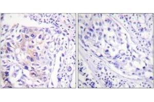 Immunohistochemistry analysis of paraffin-embedded human breast carcinoma, using CBL (Phospho-Tyr774) Antibody. (CBL Antikörper  (pTyr774))