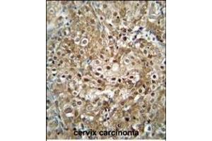 C antibody (C-term) (ABIN654740 and ABIN2844426) immunohistochemistry analysis in formalin fixed and paraffin embedded human cervix carcinoma followed by peroxidase conjugation of the secondary antibody and DAB staining. (CF153 (AA 230-259), (C-Term) Antikörper)