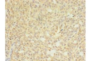Immunohistochemistry of paraffin-embedded human breast cancer using ABIN7148714 at dilution of 1:100 (CTP Synthase Antikörper  (AA 300-554))
