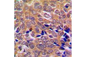 Immunohistochemical analysis of ABL1/2 staining in human breast cancer formalin fixed paraffin embedded tissue section. (ABL1/2 Antikörper  (C-Term))