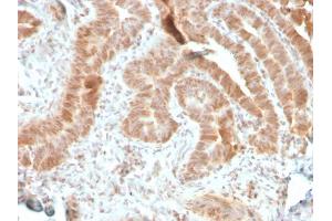 Formalin-fixed, paraffin-embedded human colon carcinoma stained with AKT1 Recombinant Mouse Monoclonal Antibody (rAKT1/2491). (Rekombinanter AKT1 Antikörper  (AA 85-189))