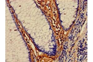 Immunohistochemistry of paraffin-embedded human colon cancer using ABIN7160053 at dilution of 1:100 (MAP3K7 Antikörper  (AA 101-400))