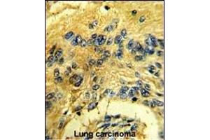 Formalin-fixed and paraffin-embedded human lung carcinoma reacted with CDK3 Antibody (N-term Y19), which was peroxidase-conjugated to the secondary antibody, followed by DAB staining. (CDK3 Antikörper  (N-Term))