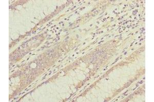 Immunohistochemistry of paraffin-embedded human colon cancer using ABIN7149316 at dilution of 1:100 (DYNC1I1 Antikörper  (AA 1-220))