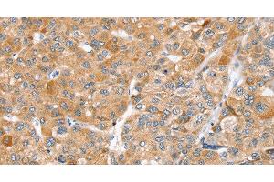 Immunohistochemistry of paraffin-embedded Human liver cancer using ZFP36L2 Polyclonal Antibody at dilution of 1:45 (ZFP36L2 Antikörper)