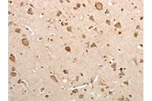 The image on the left is immunohistochemistry of paraffin-embedded Human brain tissue using ABIN7131078(SLC12A1 Antibody) at dilution 1/15, on the right is treated with fusion protein.