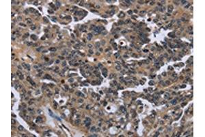 The image on the left is immunohistochemistry of paraffin-embedded Human ovarian cancer tissue using ABIN7129926(ITGAE Antibody) at dilution 1/50, on the right is treated with fusion protein.