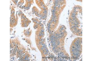 Immunohistochemistry of Human breast cancer using PARD6A Polyclonal Antibody at dilution of 1:60 (PARD6A Antikörper)