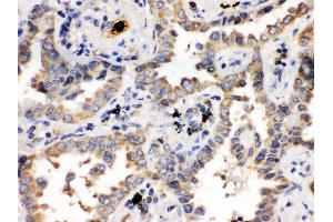 Anti- ULK3 Picoband antibody, IHC(P) IHC(P): Human Lung Cancer Tissue (ULK3 Antikörper  (C-Term))