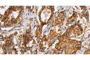 Immunohistochemistry of paraffin-embedded Human liver cancer tissue using SLC5A11 Polyclonal Antibody at dilution 1:35