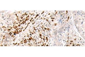 Immunohistochemistry of paraffin-embedded Human cervical cancer tissue using HLA-B Polyclonal Antibody at dilution of 1:30(x200) (HLA-B Antikörper)