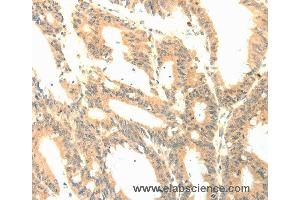 Immunohistochemistry of Human colon cancer using PTGES3 Polyclonal Antibody at dilution of 1:50 (CDK5R1 Antikörper)