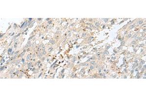 Immunohistochemistry of paraffin-embedded Human cervical cancer tissue using TPMT Polyclonal Antibody at dilution of 1:60(x200)