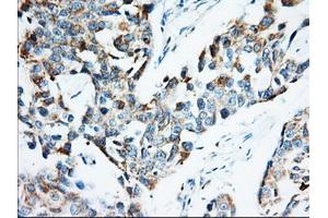 Immunohistochemical staining of paraffin-embedded Adenocarcinoma of Human colon tissue using anti-IGF2BP2 mouse monoclonal antibody. (IGF2BP2 Antikörper)
