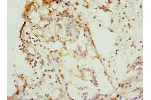 Immunohistochemistry of paraffin-embedded human breast cancer using ABIN7146875 at dilution of 1:100 (CSNK1G1 Antikörper  (Isoform gamma 1))