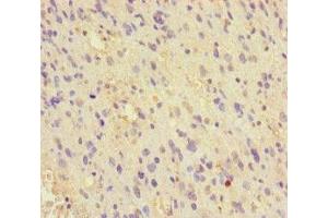 Immunohistochemistry of paraffin-embedded human glioma using ABIN7159738 at dilution of 1:100 (MCRS1 Antikörper  (AA 1-138))
