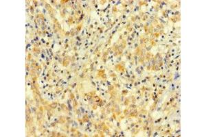 Immunohistochemistry of paraffin-embedded human lung cancer using ABIN7167948 at dilution of 1:100 (ARHGAP27 Antikörper  (AA 1-300))