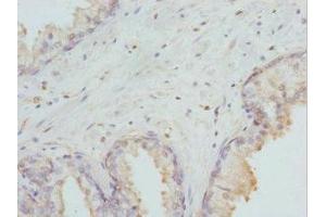 Immunohistochemistry of paraffin-embedded human prostate cancer using ABIN7155677 at dilution of 1:100 (DLX2 Antikörper  (AA 1-140))