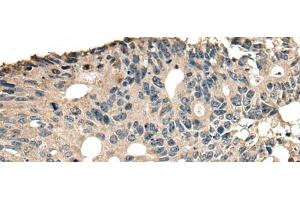 Immunohistochemistry of paraffin-embedded Human colorectal cancer tissue using SLAMF7 Polyclonal Antibody at dilution of 1:30(x200) (SLAMF7 Antikörper)