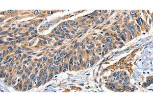 Immunohistochemistry of paraffin-embedded Human esophagus cancer tissue using EFNB2 Polyclonal Antibody at dilution 1:80 (Ephrin B2 Antikörper)
