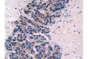 IHC-P analysis of Human Breast Cancer Tissue, with DAB staining. (Endoglin Antikörper  (AA 26-136))