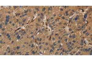 Immunohistochemistry of paraffin-embedded Human liver cancer tissue using UBE2S Polyclonal Antibody at dilution 1:40 (UBE2S Antikörper)