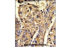 Formalin-fixed and paraffin-embedded human hepatocarcinoma reacted with HNRPL Antibody (C-term), which was peroxidase-conjugated to the secondary antibody, followed by DAB staining. (HNRNPL Antikörper  (C-Term))